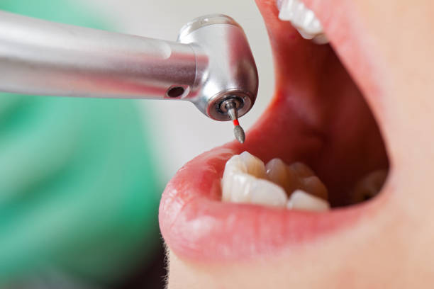 Best Emergency Dental Care for Broken or Chipped Teeth in Parkwood, WA